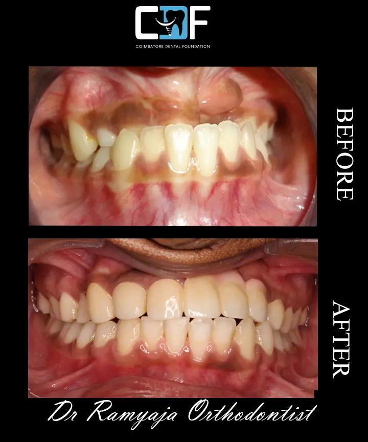 Braces Intraoral